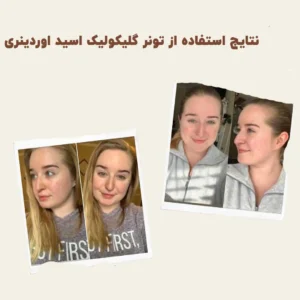 before after Glycolic Acid 12 min