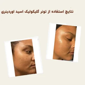 before after Glycolic Acid 2 min