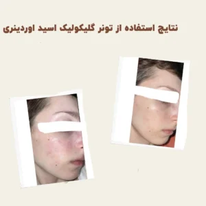 before after Glycolic Acid 3 min