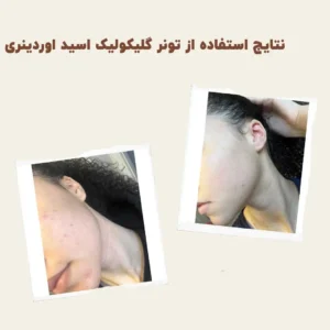 before after Glycolic Acid 4 min