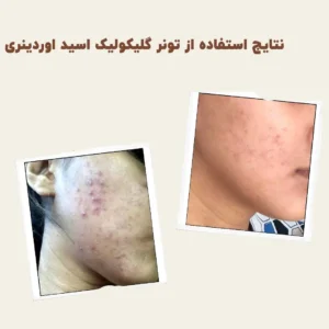 before after Glycolic Acid 5 min