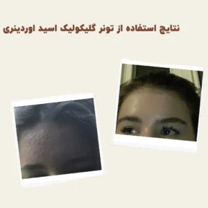 before after Glycolic Acid 6 min