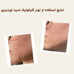 before after Glycolic Acid 7 min
