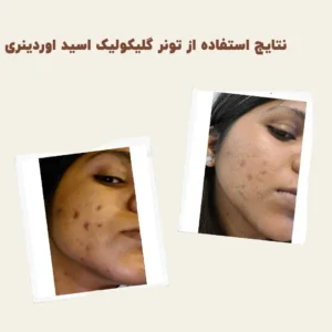 before after Glycolic Acid 8 min