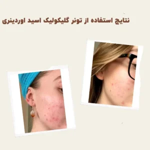 before after Glycolic Acid 9 min