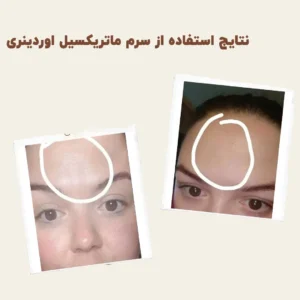 before after Matrixyl 1 min