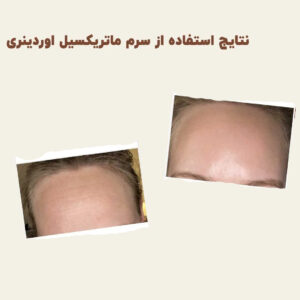 before after Matrixyl 3 min