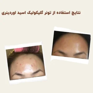 before after The Ordinary Glycolic 7 Toning 1 min