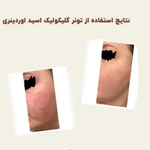 before after The Ordinary Glycolic 7 Toning 2 min