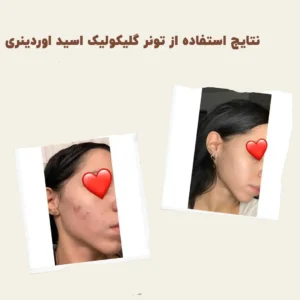 before after The Ordinary Glycolic 7 Toning 4 min