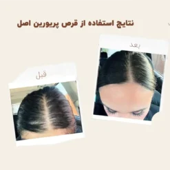 کپسول پریورین بایر ضدریزش هورمونی و ارثی آلمانی (اصل+به قیمت پخش) 32 before after priorin 1 1