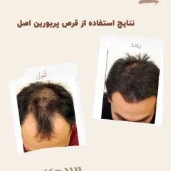 کپسول پریورین بایر ضدریزش هورمونی و ارثی آلمانی (اصل+به قیمت پخش) 33 before after priorin 2 1