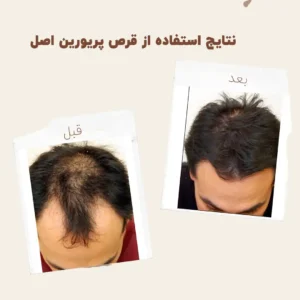 before after priorin 2 2