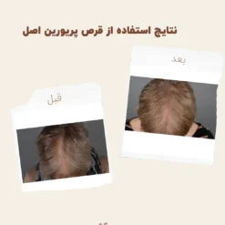 کپسول پریورین بایر ضدریزش هورمونی و ارثی آلمانی (اصل+به قیمت پخش) 34 before after priorin 3
