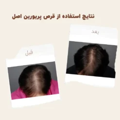 کپسول پریورین بایر ضدریزش هورمونی و ارثی آلمانی (اصل+به قیمت پخش) 35 before after priorin 4 2