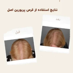 کپسول پریورین بایر ضدریزش هورمونی و ارثی آلمانی (اصل+به قیمت پخش) 36 before after priorin 5