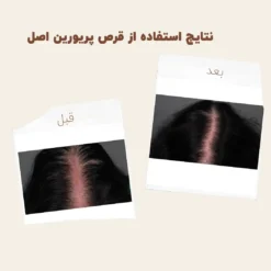 کپسول پریورین بایر ضدریزش هورمونی و ارثی آلمانی (اصل+به قیمت پخش) 37 before after priorin 6 1
