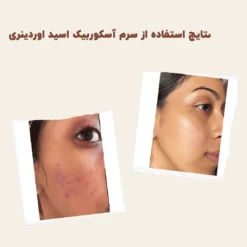 سرم اسکوربیک اسید اوردینری ویتامین سی 8%+ آلفا آربوتین 2% 12 before after zhinor2aAscorbicAcid8AlphaArbutin2 ۱