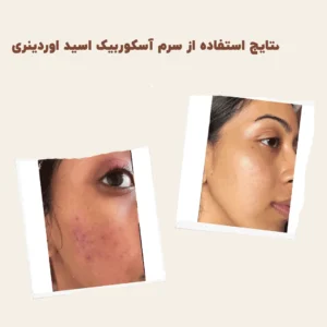 before after zhinor2aAscorbicAcid8AlphaArbutin2 ۱