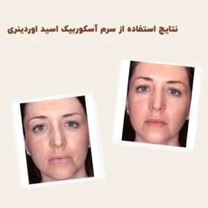 before after zhinora3AscorbicAcid8AlphaArbutin2 2