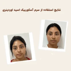 سرم اسکوربیک اسید اوردینری ویتامین سی 8%+ آلفا آربوتین 2% 11 before after zhinora3AscorbicAcid8AlphaArbutin2 3