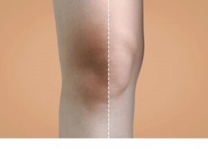 compare woman knee before after 260nw 2307441889 1
